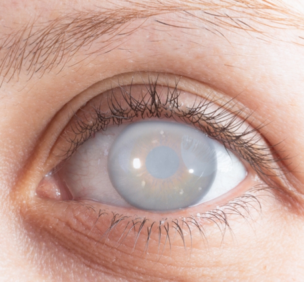 تكلفة-عملية-المياه-البيضاء-في-العين-2