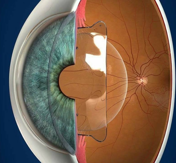 زراعة العدسات